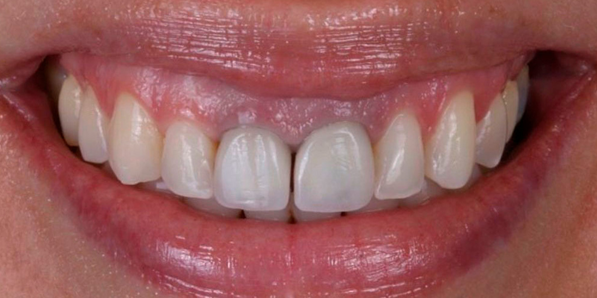antes-e-depois-ipv-03-antes