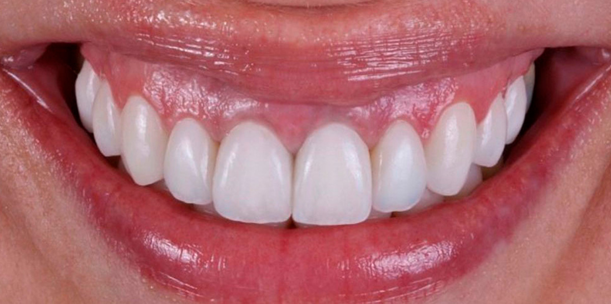 antes-e-depois-ipv-03-depois