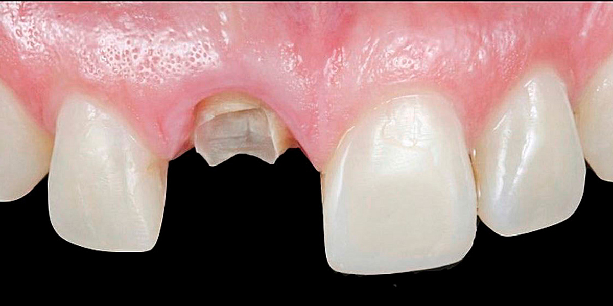 antes-e-depois-ipv-05-antes