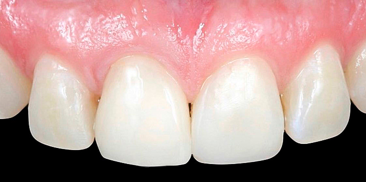 antes-e-depois-ipv-05-depois