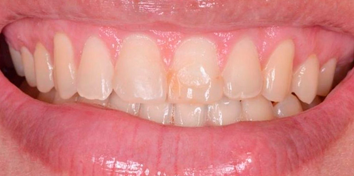 antes-e-depois-ipv-06-antes
