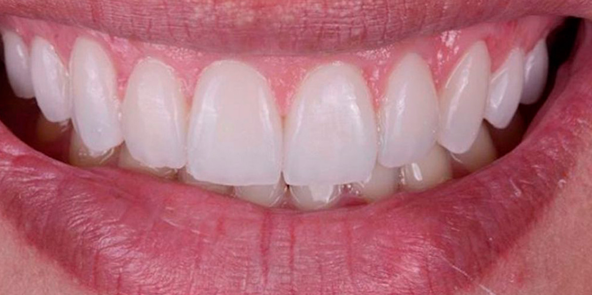 antes-e-depois-ipv-06-depois