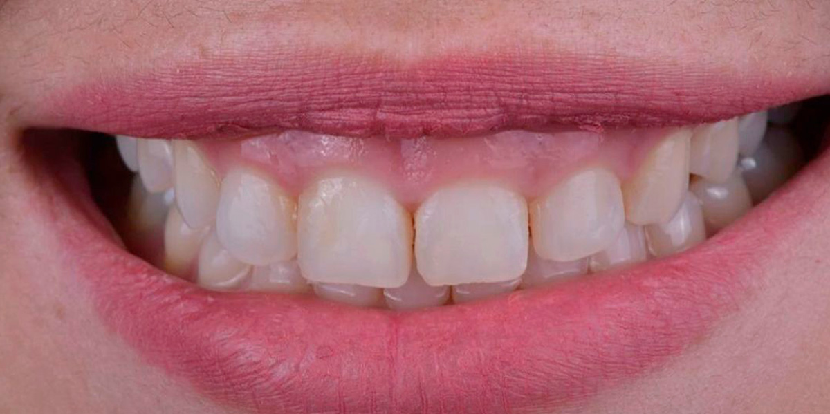 antes-e-depois-ipv-12-antes