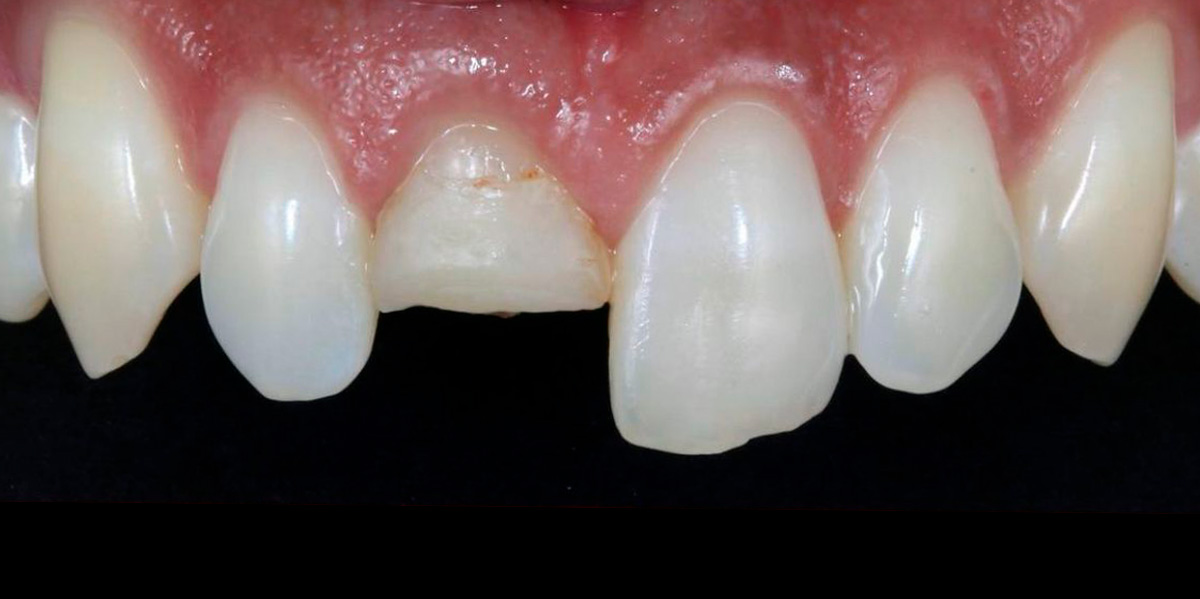 antes-e-depois-ipv-16-antes