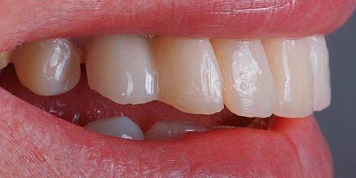 antes-e-depois-ipv-17-antes