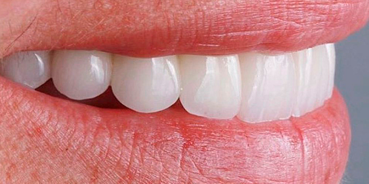 antes-e-depois-ipv-17-depois