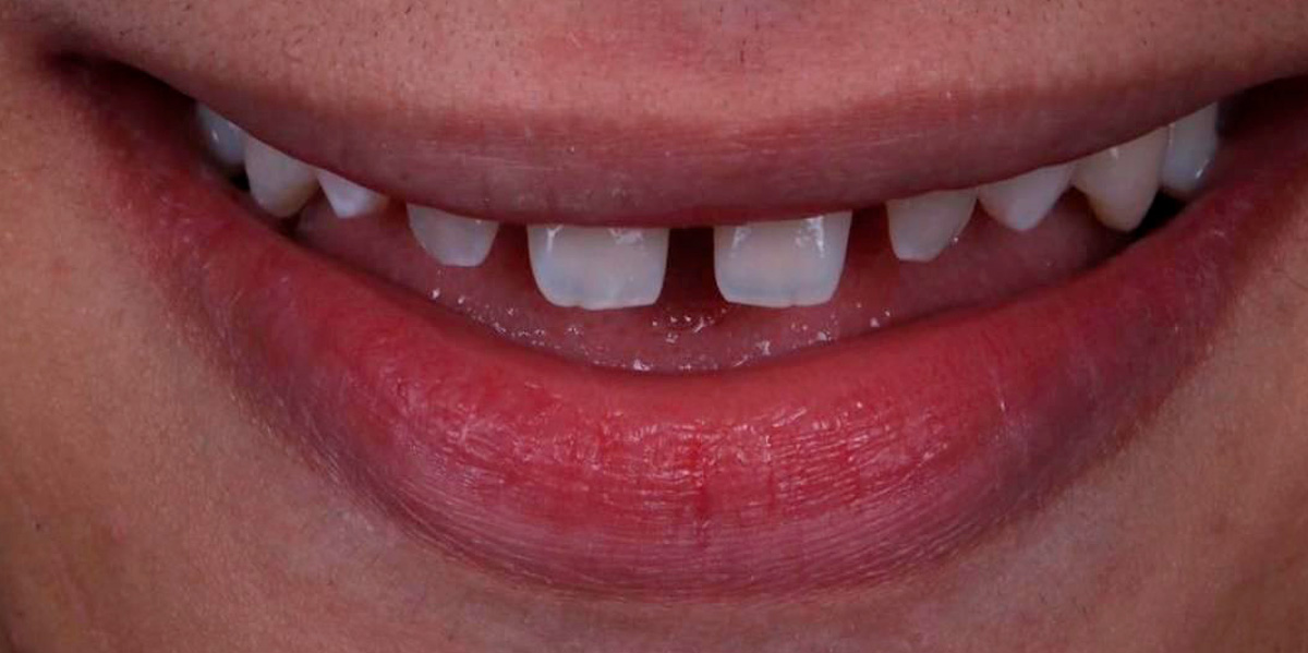 antes-e-depois-ipv-23-antes