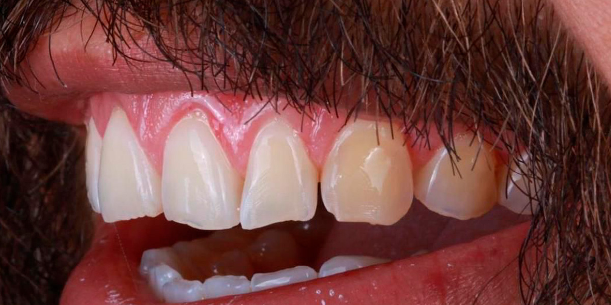 antes-e-depois-ipv-26-antes
