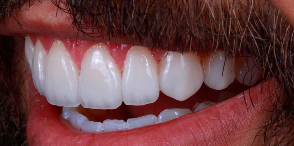 antes-e-depois-ipv-26-depois