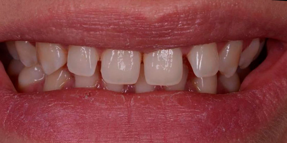 antes-e-depois-ipv-28-antes