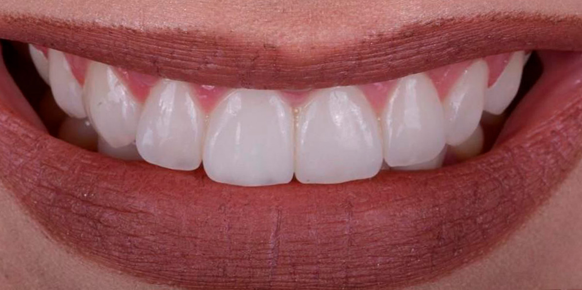 antes-e-depois-ipv-28-depois