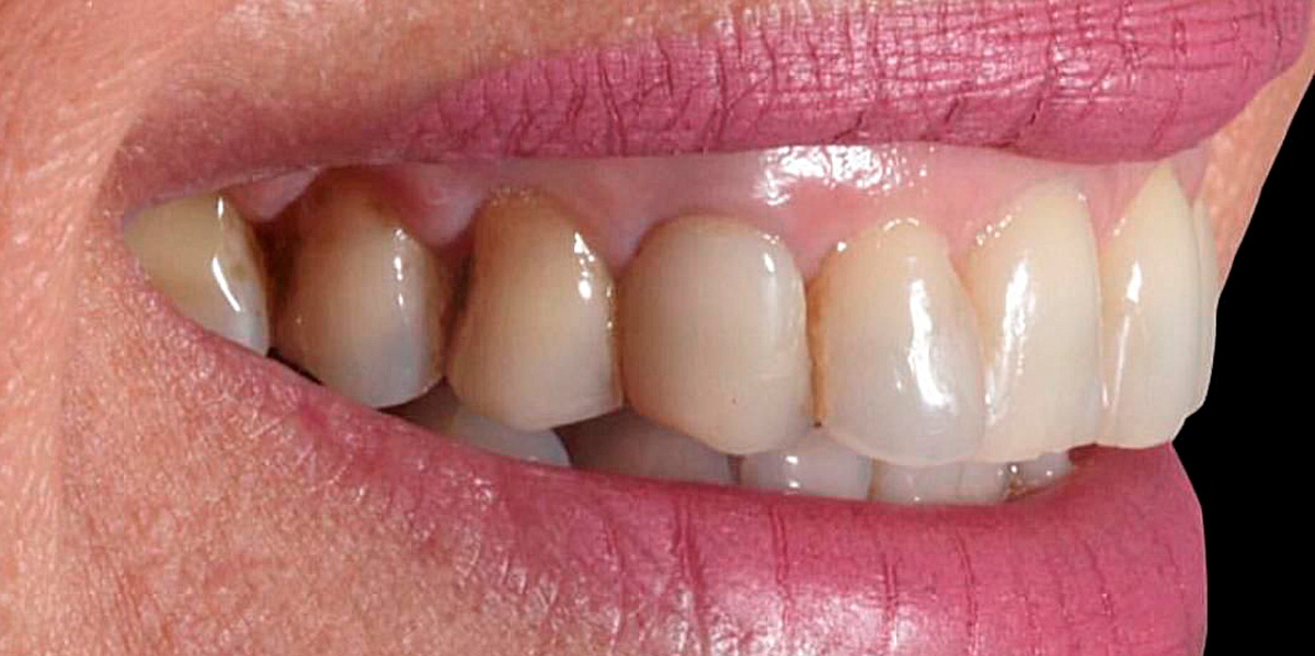 antes-e-depois-ipv-29-antes