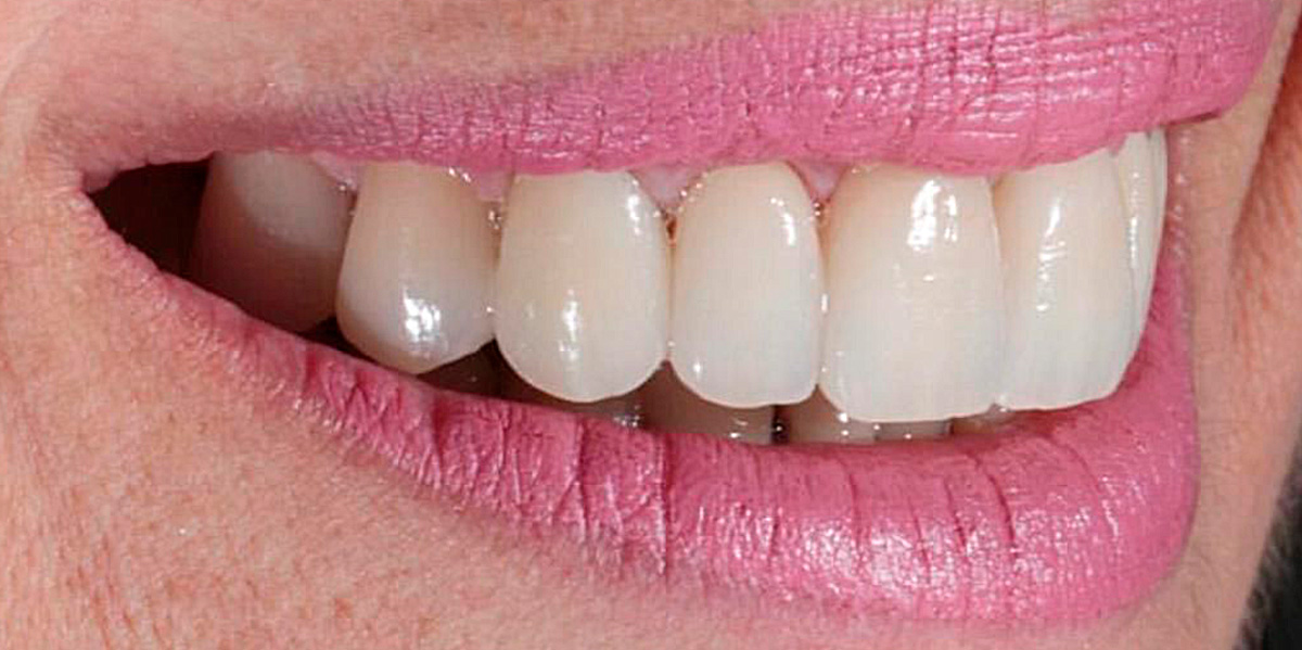 antes-e-depois-ipv-29-depois